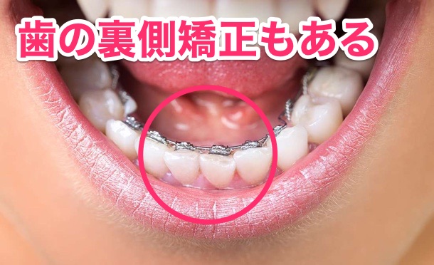 C：歯の裏側ブラケット（矯正器具）