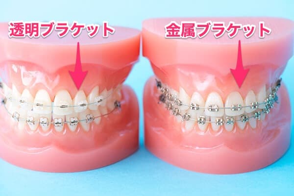 A・B：歯の表側へ矯正器具の場合